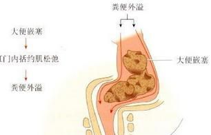 梦见大便失禁在裤子里,做梦梦见拉屎在裤子里是什么意思图2