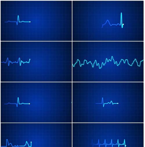 符号心电图波动心,心电图怎么看心电图讲解心电图t波改变图1
